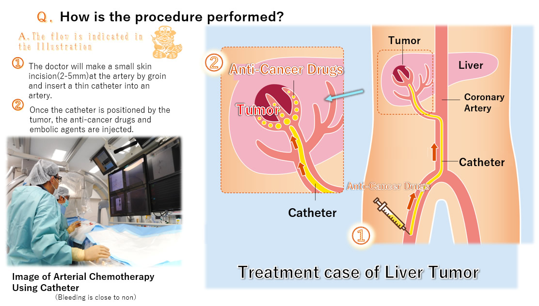 Intra-arterial Chemotherapy