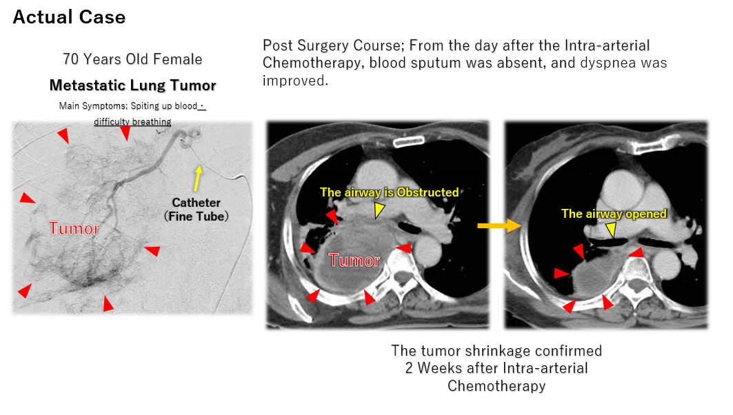 Intra-arterial Chemotherapy